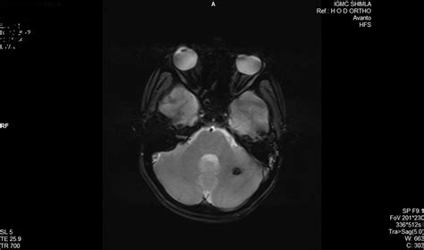 Unusual Delayed Presentation Of Head Trauma Complicating Outcome Of