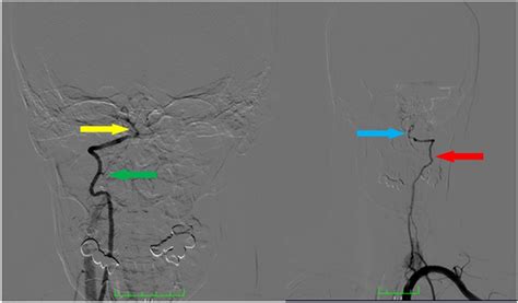 Dsa Image Showing The Hypoplastic Right Vertebral Artery Green Arrow