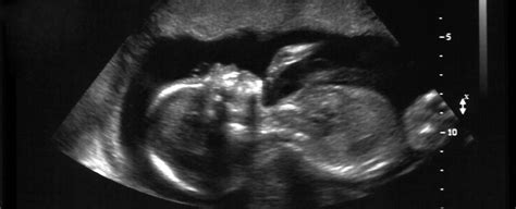 1 In 50 Million Chance US Woman With Rare Double Uterus Is Pregnant In