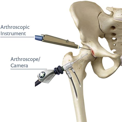 Hip Arthroscopy Perth | Dr Daniel Fick