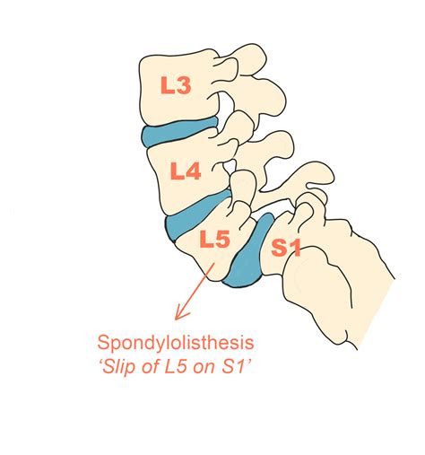 Spondylolisthesis Grade