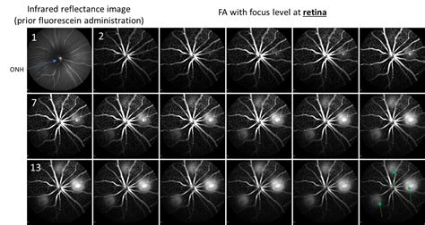 Retinal Neovascularization