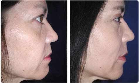 Facial Fat Transfer Before & After Photos Las Vegas | Dr. Troell