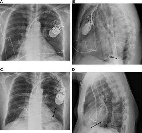 Posteroanterior A And Lateral B Chest X Rays Demonstrating The