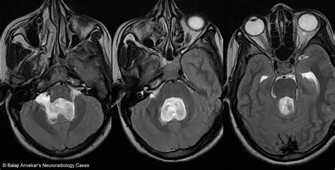 Dr Balaji Anvekar FRCR: Intraventricular Arachnoid cyst MRI