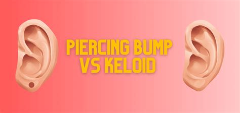 Piercing Bump Vs Keloid How To Tell The Difference 2023 Update Drug