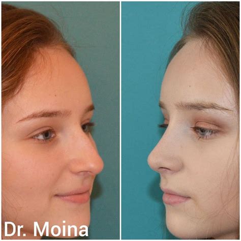 Pin De Rinoplastia Dr Moina En Rinoplastia Antes Y Después Rinoplastia