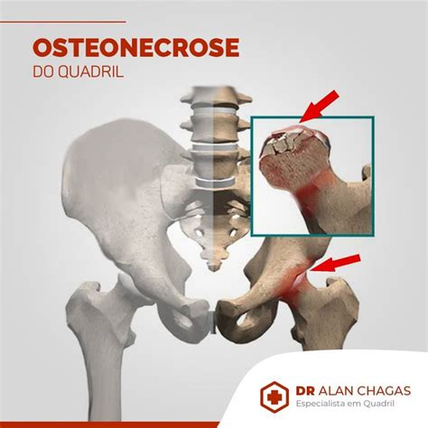 Osteonecrose No Quadril Dr Alan Chagas