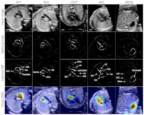 Can Ai Help Detect Congenital Heart Disease On Fetal Ultrasound