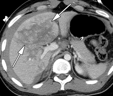 Multidetector CT Of Blunt Abdominal Trauma Radiology