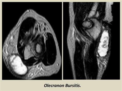 Mri Musculo Skeletal Section Bursa Of Elbow Joint