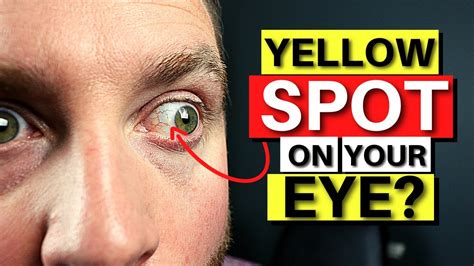 Raised Yellow Spots On Eyeballs Clipart