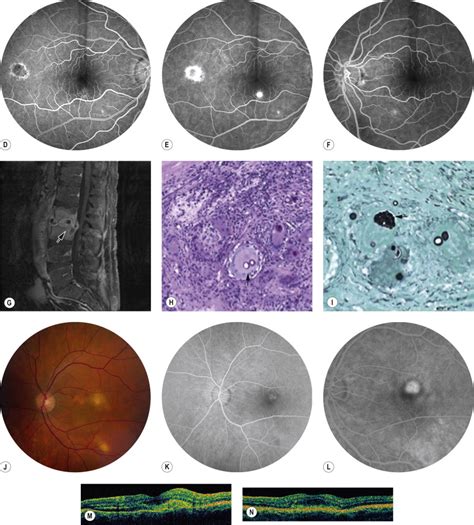 Infectious Diseases Of The Retina And Choroid Ento Key