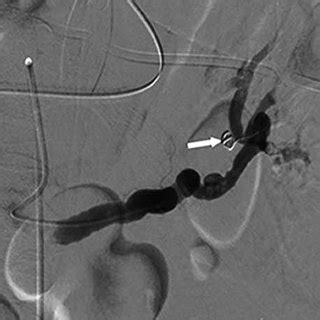 Photo Pseudoaneurysms Of The Splenic Artery A Angiogram Of Splenic