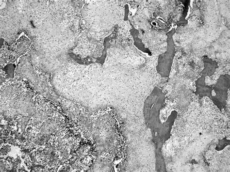 Low Power Photomicrograph This Shows Areas Of Grade II Conventional