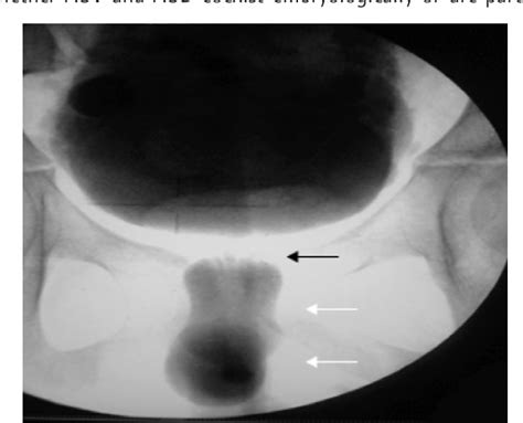 Figure 1 From Anterior Urethral Valve And Anterior Urethral