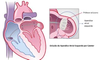 Fechamento Do Ap Ndice Atrial Esquerdo Cardiologista Dr Gilberto Nunes