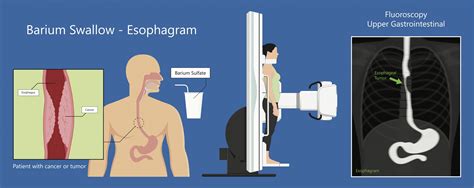 Barium Swallow G And L Surgical Clinic Dr Ganesh Ramalingam