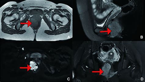 Recurrence Treatment Pelvic Mri Showing A Mass Measuring Cm