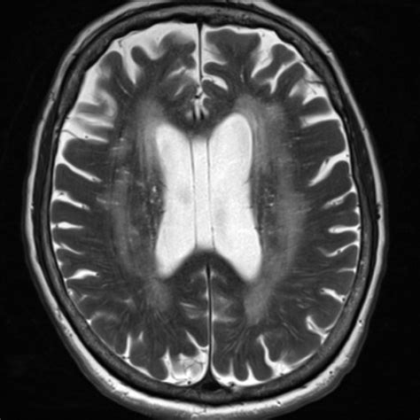 Chronic Microvascular Ischemic Changes - slideshare