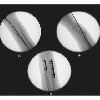 A B Intraoperative Fluoroscopic Images Showing Two Views Of Flexion