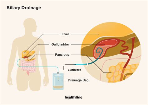 Bile Duct Drain Purpose Procedure Effectiveness And Outlook