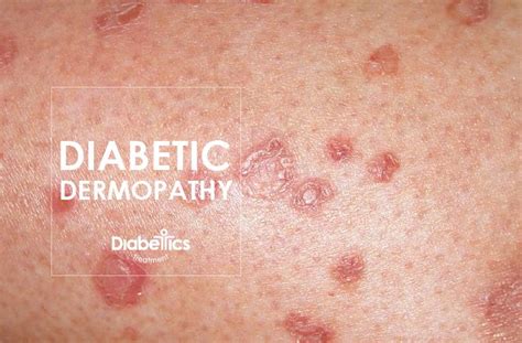 Diabetes Rashes Skin Problems