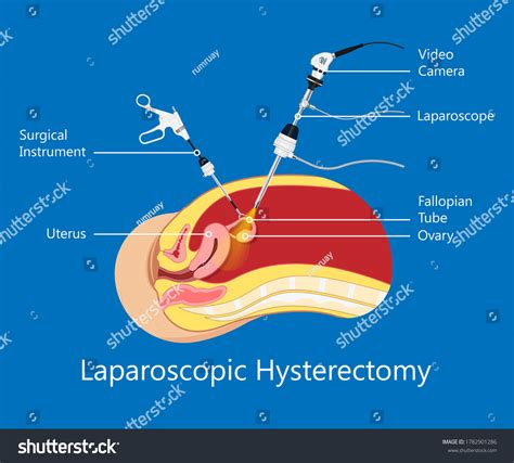 Laparoscopic Hysterectomy Medical Surgical Treat Royalty Free Stock