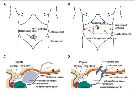Figure 1 From Single Site Multiport Vs Conventional Multiport Robot Assisted Radical