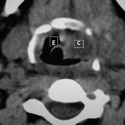 Oedema of (a) left arytenoids and left aryepiglottic fold (arrow) (b ...