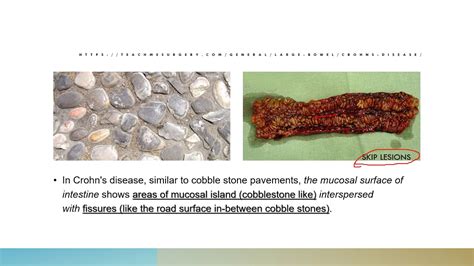 Why Is Cobble Stone Appearance Of The Bowel Seen In Crohn S Disease