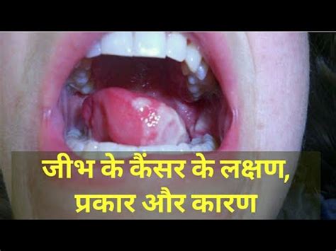 Lips Cancer Ke Lakshan Lipstutorial Org