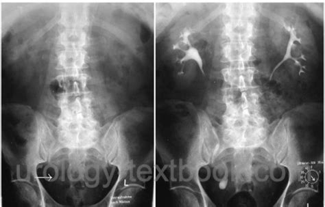 Ureterocele: Symptoms, Diagnosis and Treatment