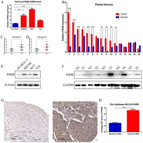 P4hb A Novel Diagnostic And Prognostic Biomarker For Bladder Carcinoma