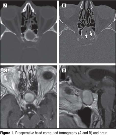 Figure 1 From Sphenoid Sinus Fungus Ball With Skull Base Erosion Semantic Scholar