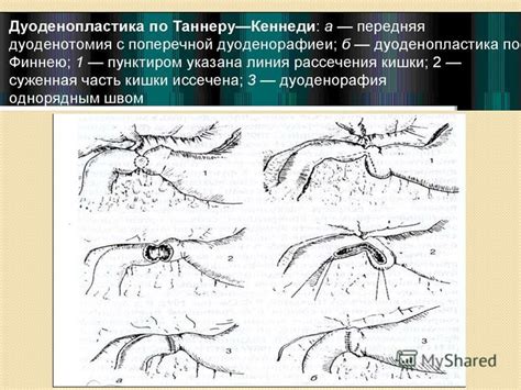 Презентация на тему: "Дуоденопластика в лечении осложненных ...