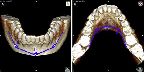 Maxillary And Mandibular Tori