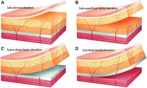 Schematic Illustrations Showing The Thickness Control Of Flap