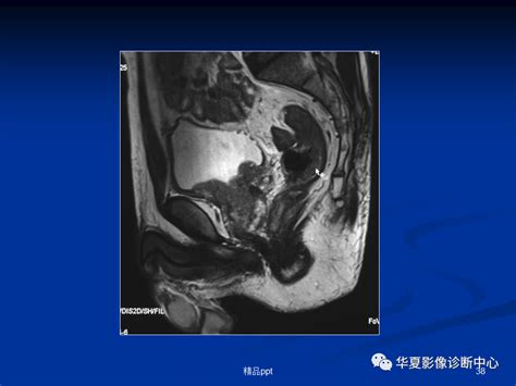 前列腺癌的磁共振成像诊断 Medscicn