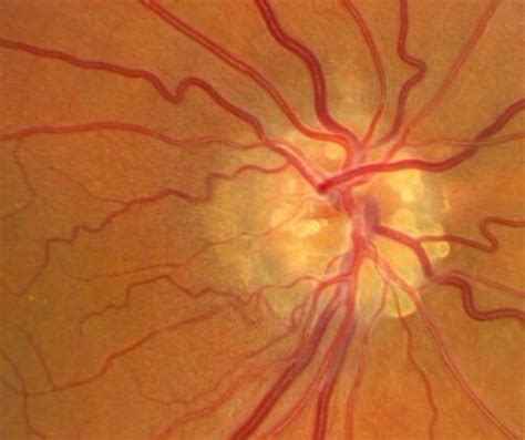 What Are Drusen And Yellow Eye: Causes And Diagnosis