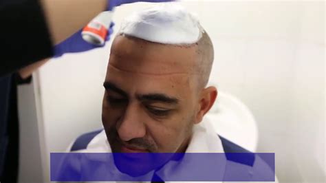 Hair Transplant Dr Emrah Cinik Youtube