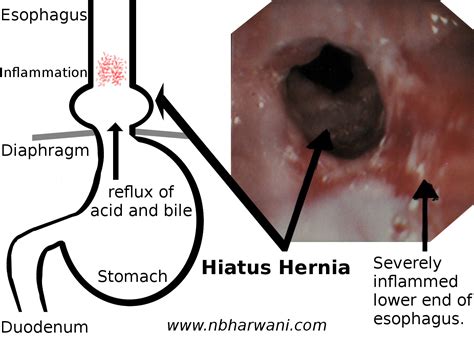 Esophageal Cancer Dr Noorali Bharwani