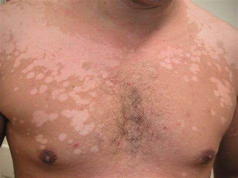 Pityriasis Versicolor Picture Image On Medicinenet The Best Porn Website