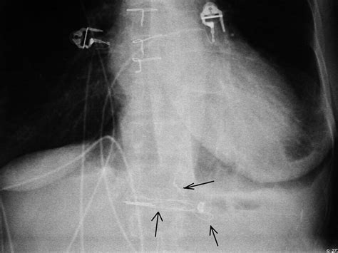 Medical Devices Of The Chest Radiographics