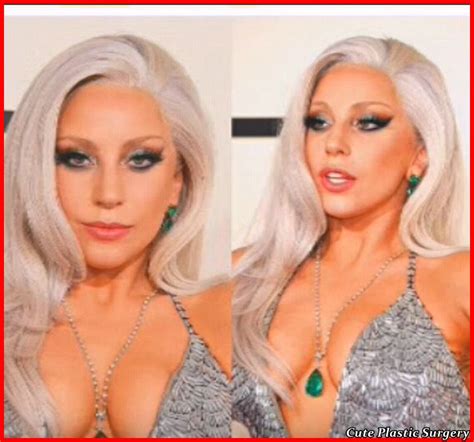 Lady Gaga Plastic Surgery Before And After Celebrities Plastic Surgery