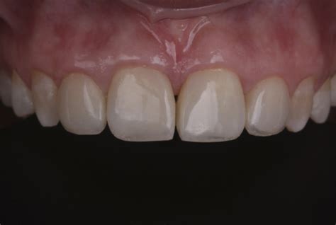 A Combined Approach For Diastema Closure Styleitaliano Org