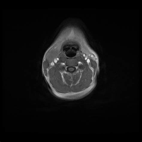 Branchial Cleft Cyst Diagram