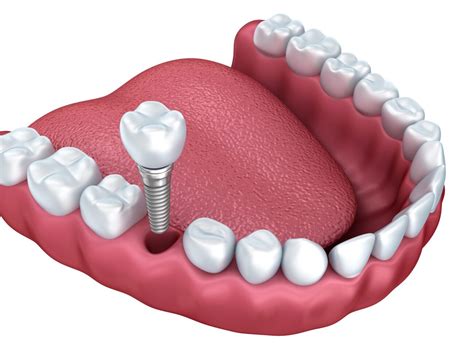 Implant-Supported Crown Chester Springs PA | Dental Implant