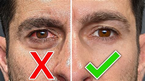 MORE ATTRACTIVE EYES In 3 DAYS 6 Tricks To Fix Dark Circles Eye Bags