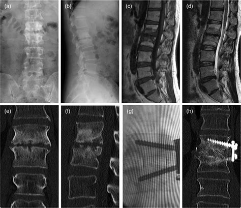 A Typical Case Was Intraoperatively Supplemented With Lateral Fixation